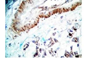 Human stomach cancer tissue was stained by rabbit Anti-Spexin prepro (36-58)  (H) Antiserum (Spexin 抗体  (Preproprotein))