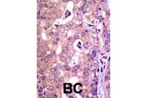 Formalin-fixed and paraffin-embedded human cancer tissue reacted with the primary antibody, which was peroxidase-conjugated to the secondary antibody, followed by AEC staining. (USP1 抗体  (C-Term))
