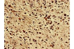 Immunohistochemistry analysis of human glioma using ABIN7176355 at dilution of 1:100 (ZNF529 抗体  (AA 393-563))
