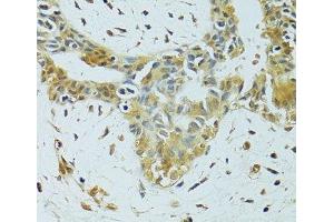 Immunohistochemistry of paraffin-embedded Human breast cancer using METTL13 Polyclonal Antibody at dilution of 1:100 (40x lens). (METTL13 抗体)