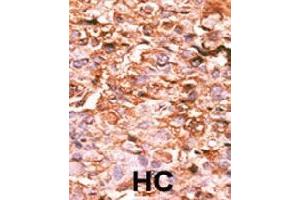 Immunohistochemistry (Formalin/PFA-fixed paraffin-embedded sections) of human hepatocarcinoma with HIST1H3B3 (phospho S10) polyclonal antibody , followed by peroxidase-conjugated secondary antibody and AEC staining. (Histone H3.1 抗体  (pSer10))