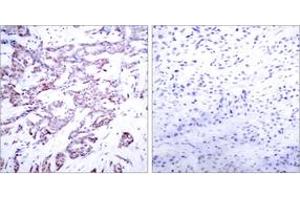 Immunohistochemistry analysis of paraffin-embedded human breast carcinoma, using STAT6 (Phospho-Thr645) Antibody. (STAT6 抗体  (pThr645))