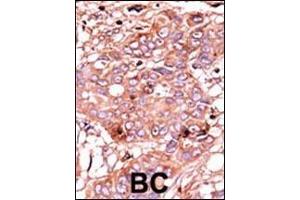 Formalin-fixed and paraffin-embedded human cancer tissue reacted with the primary antibody, which was peroxidase-conjugated to the secondary antibody, followed by AEC staining. (ABL1 抗体  (pTyr251))