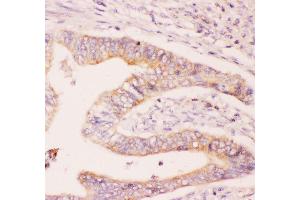 Anti-MCL1 Picoband antibody,  IHC(P): Human Intestinal Cancer Tissue (MCL-1 抗体  (AA 1-350))