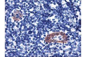 Immunohistochemical staining of paraffin-embedded Human lymphoma tissue using anti-LMCD1 mouse monoclonal antibody. (LMCD1 抗体)