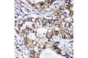 Immunohistochemistry of paraffin-embedded Human colon carcinoma using TSN Rabbit pAb  at dilution of 1:100 (40x lens). (Translin 抗体  (AA 50-150))