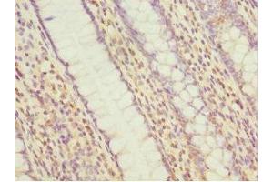 Immunohistochemistry of paraffin-embedded human colon cancer using ABIN7160535 at dilution of 1:100 (MYLK3 抗体  (AA 1-240))