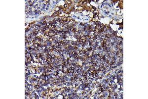 Immunohistochemistry of paraffin-embedded Human anaplastic large cell lymphoma using Human IgM Rabbit mAb (ABIN7267845) at dilution of 1:100 (40x lens). (IGHM 抗体)