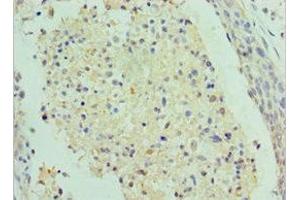 Immunohistochemistry of paraffin-embedded human cervical cancer using ABIN7155341 at dilution of 1:100 (SAP18 抗体  (AA 2-153))