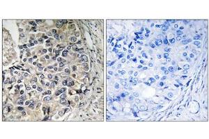 Immunohistochemistry analysis of paraffin-embedded human prostate carcinoma tissue using CMC1 antibody. (SLC25A12 抗体  (Internal Region))