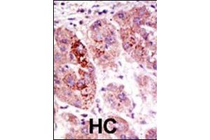 Formalin-fixed and paraffin-embedded human cancer tissue reacted with the primary antibody, which was peroxidase-conjugated to the secondary antibody, followed by AEC staining. (USP7 抗体  (C-Term))