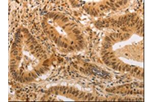The image on the left is immunohistochemistry of paraffin-embedded Human colon cancer tissue using ABIN7189699(ADRA1B Antibody) at dilution 1/20, on the right is treated with synthetic peptide. (ADRA1B 抗体)