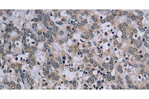 Immunohistochemistry of paraffin-embedded Human liver cancer tissue using TP53AIP1 Polyclonal Antibody at dilution 1:50 (TP53AIP1 抗体)