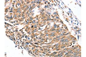 The image on the left is immunohistochemistry of paraffin-embedded Human lung cancer tissue using ABIN7192291(SDC3 Antibody) at dilution 1/30, on the right is treated with synthetic peptide. (SDC3 抗体)
