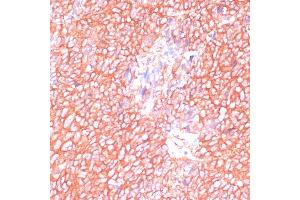 Immunohistochemistry of paraffin-embedded human oophoroma using MOB4 antibody (ABIN6132926, ABIN6143935, ABIN6143936 and ABIN6220703) at dilution of 1:100 (40x lens). (MOBKL3 抗体  (AA 1-225))