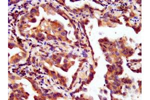 IHC image of ABIN7157898 diluted at 1:200 and staining in paraffin-embedded human lung cancer performed on a Leica BondTM system. (LAMC2 抗体  (AA 417-588))