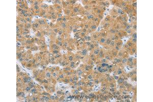 Immunohistochemistry of Human liver cancer using CYP2C9 Polyclonal Antibody at dilution of 1:35 (CYP2C9 抗体)