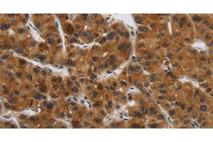 Immunohistochemistry of paraffin-embedded Human liver cancer tissue using GATA5 Polyclonal Antibody at dilution 1:50 (GATA5 抗体)