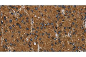 Immunohistochemistry of paraffin-embedded Human liver cancer tissue using MIER2 Polyclonal Antibody at dilution 1:60 (MIER2 抗体)