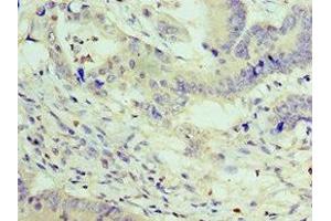 Immunohistochemistry of paraffin-embedded human colon cancer using ABIN7176056 at dilution of 1:100 (ZEB2 抗体  (AA 1050-1214))
