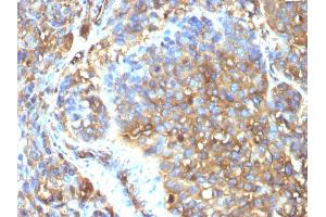 Formalin-fixed, paraffin-embedded human Melanoma stained with Moesin Mouse Monoclonal Antibody (MSN/493). (Moesin 抗体)