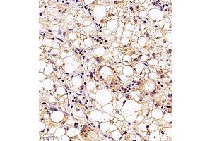 Immunohistochemistry (Paraffin-embedded Sections) (IHC (p)) image for anti-Methylenetetrahydrofolate Dehydrogenase (NADP+ Dependent) 1, Methenyltetrahydrofolate Cyclohydrolase, Formyltetrahydrofolate Synthetase (MTHFD1) antibody (ABIN7074609)