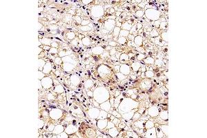 Immunohistochemistry analysis of paraffin embedded human liver cancer using MTHFD1 (ABIN7074609) at dilution of 1: 700 (MTHFD1 抗体)