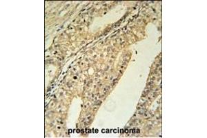 TME Antibody (N-term) (ABIN651651 and ABIN2840344) immunohistochemistry analysis in formalin fixed and paraffin embedded human prostate carcinoma followed by peroxidase conjugation of the secondary antibody and DAB staining. (TMEM134 抗体  (N-Term))