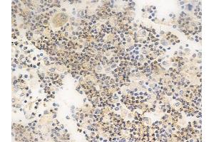 ABIN6265584 and ABIN6266662 at 1/100 staining human colon carcinoma by IHC-P. (TIMP4 抗体  (C-Term))