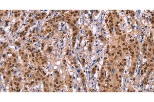 Immunohistochemistry of paraffin-embedded Human gastric cancer tissue using Ephrin A5 Polyclonal Antibody at dilution 1:40 (Ephrin A5 抗体)