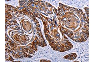 The image on the left is immunohistochemistry of paraffin-embedded Human esophagus cancer tissue using ABIN7190455(DEFA1 Antibody) at dilution 1/15, on the right is treated with synthetic peptide. (alpha Defensin 1 抗体)