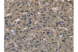 The image on the left is immunohistochemistry of paraffin-embedded Human liver cancer tissue using ABIN7191092(IMPAD1 Antibody) at dilution 1/20, on the right is treated with synthetic peptide. (IMPAD1 抗体)