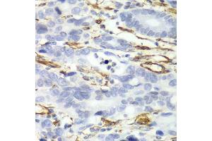 Immunohistochemistry of paraffin-embedded human gastric cancer using CALD1 antibody.
