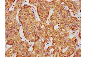 IHC image of ABIN7146858 diluted at 1:1000 and staining in paraffin-embedded human liver cancer performed on a Leica BondTM system.