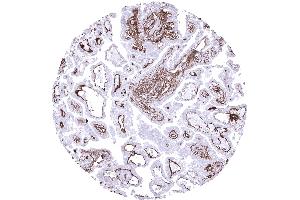 Papillary renal cell carcinoma showing a delicate collagen IV positive membrane between tumor cells and the stroma and an intense staining of vessels (Recombinant Collagen IV 抗体)
