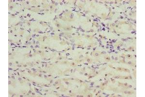 Immunohistochemistry of paraffin-embedded human gastric cancer using ABIN7173269 at dilution of 1:100 (TMEM71 抗体  (AA 1-210))