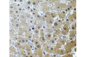 Immunohistochemistry of paraffin-embedded Human liver damage using RNF166 Polyclonal Antibody (RNF166 抗体)