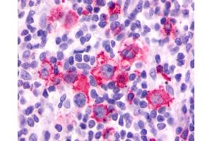Anti-F2RL3 / PAR4 antibody IHC of human Lymph Node, Hodgkins Lymphoma. (F2RL3 抗体  (Cytoplasmic Domain))