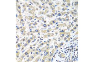 Immunohistochemistry of paraffin-embedded human liver cancer using IL2 antibody at dilution of 1:100 (40x lens). (IL-2 抗体)
