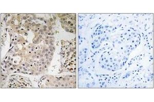 Immunohistochemistry analysis of paraffin-embedded human breast carcinoma tissue, using MRPL41 Antibody. (MRPL41 抗体  (AA 81-130))