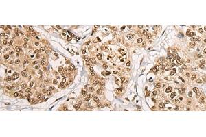 Immunohistochemistry of paraffin-embedded Human prost at e cancer tissue using PHF21A Polyclonal Antibody at dilution of 1:50(x200) (PHF21A 抗体)