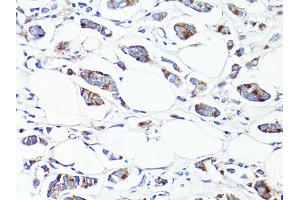 Immunohistochemistry of paraffin-embedded human breast cancer using S100A10 antibody (ABIN6290226) at dilution of 1:100 (40x lens). (S100A10 抗体)