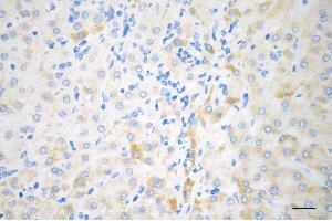Immunohistochemistry was performed on paraffin-embedded human hepatocarcinoma using BCKDK antibody (ABIN7797783), 1:200). (BCKDK 抗体)