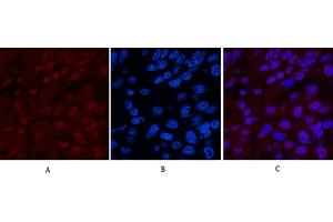 Immunofluorescence analysis of human liver cancer tissue. (XRCC4 抗体)