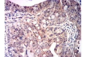 Immunohistochemical analysis of paraffin-embedded rectum cancer tissues using RRM1 mouse mAb with DAB staining. (RRM1 抗体  (AA 541-792))