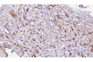 ABIN6272698 at 1/100 staining Human liver cancer tissue by IHC-P. (Leukotriene B4 Receptor/BLT 抗体)