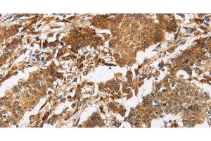 Immunohistochemistry of paraffin-embedded Human gasrtic cancer tissue using CALU Polyclonal Antibody at dilution 1:40 (CALU 抗体)