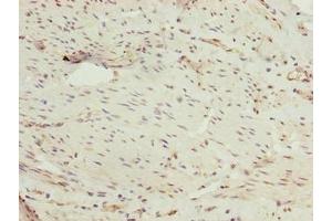 Immunohistochemistry of paraffin-embedded human bladder cancer using ABIN7162864 at dilution of 1:100 (PPIL4 抗体  (AA 1-492))