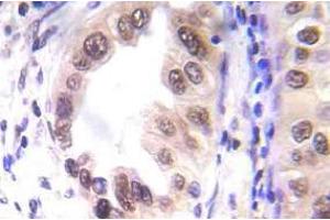 Immunohistochemistry (IHC) analyzes of p-STAT1 antibody in paraffin-embedded human lung carcinoma tissue. (STAT1 抗体  (pSer727))