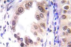 Immunohistochemistry (IHC) analyzes of p-STAT1 antibody in paraffin-embedded human lung carcinoma tissue.
